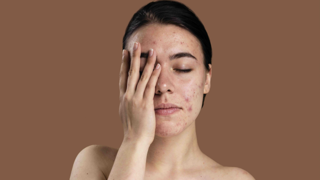 6 Penyebab Jerawat di Wajah dari Kebiasaan yang Sering Kita Hiraukan!