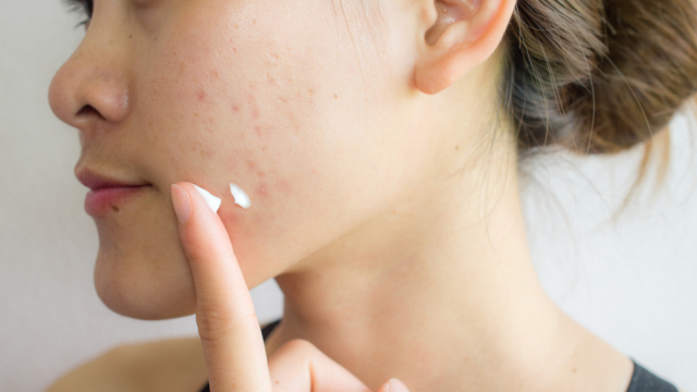 Tips Mencegah Jerawat Muncul di Muka Yang Benar dan Efektif